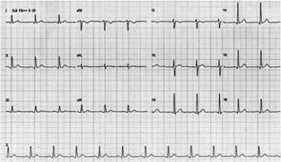 Electrocardiograma de la pregunta 362