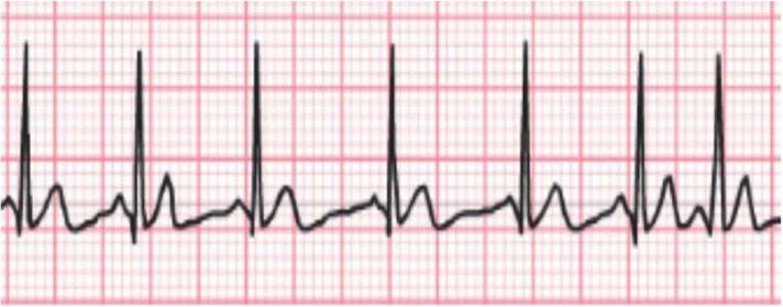 Electrocardiograma de la pregunta 425